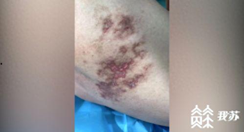 国际明星疱疹,揭秘明星背后的健康挑战